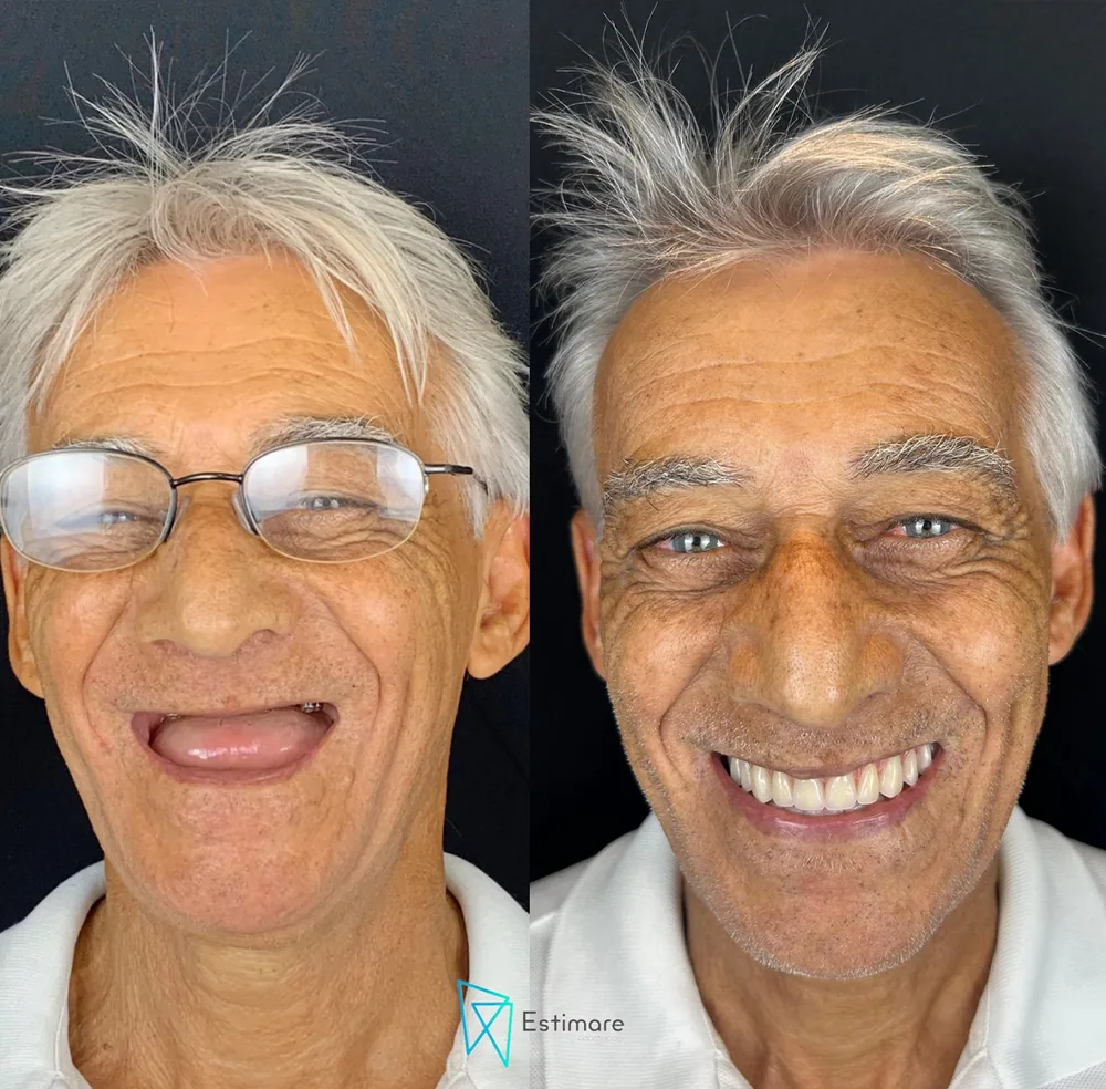 Paciente antes e depois da reabilitação com dentes fixos na Estimare Odontologia