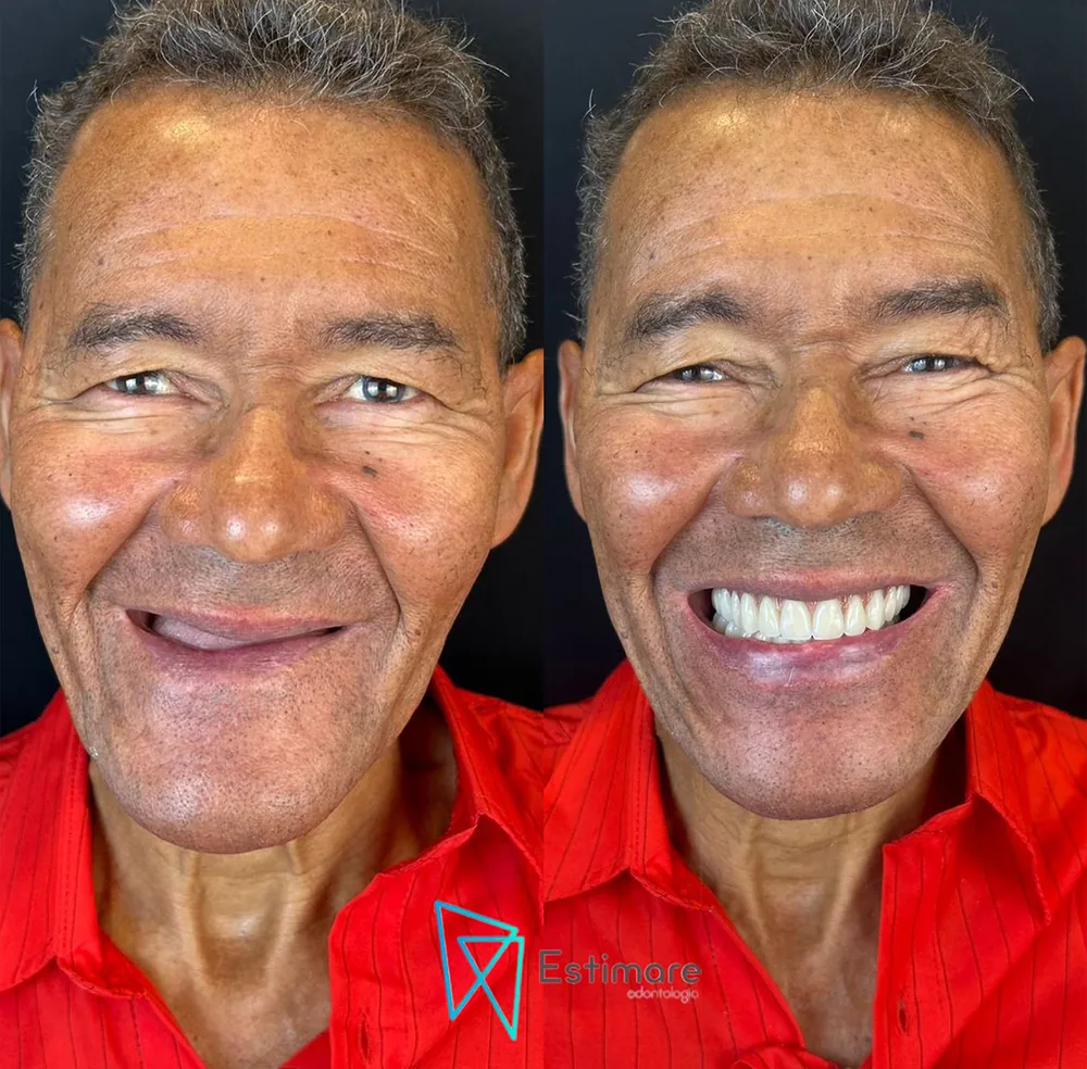 Paciente sorrindo depois do tratamento com implantes na Estimare Odontologia