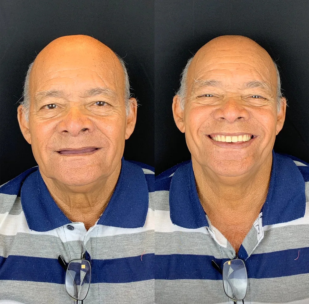 Antes e depois de paciente reabilitado com prótese fixa na Estimare