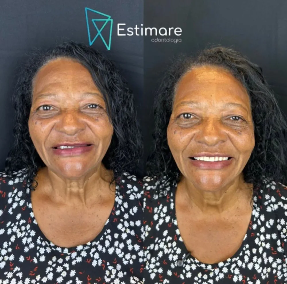 Paciente da Estimare Odontologia antes e depois do tratamento