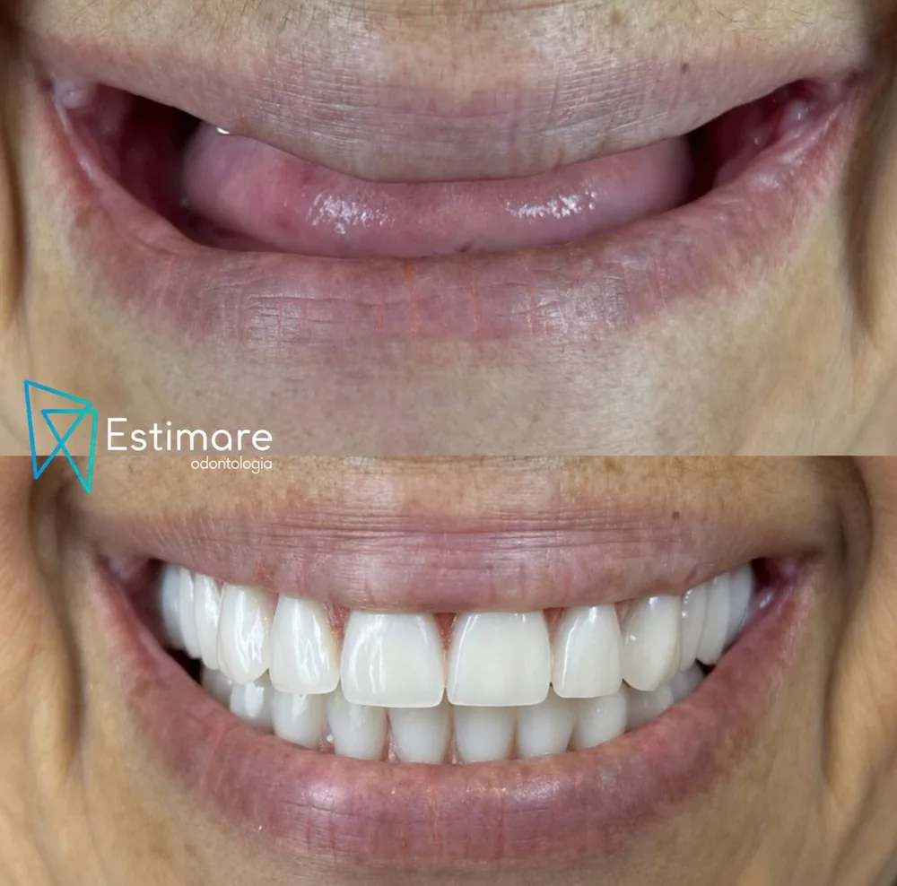 Sorriso reabilitado com prótese sobre implantes na Estimare Odontologia
