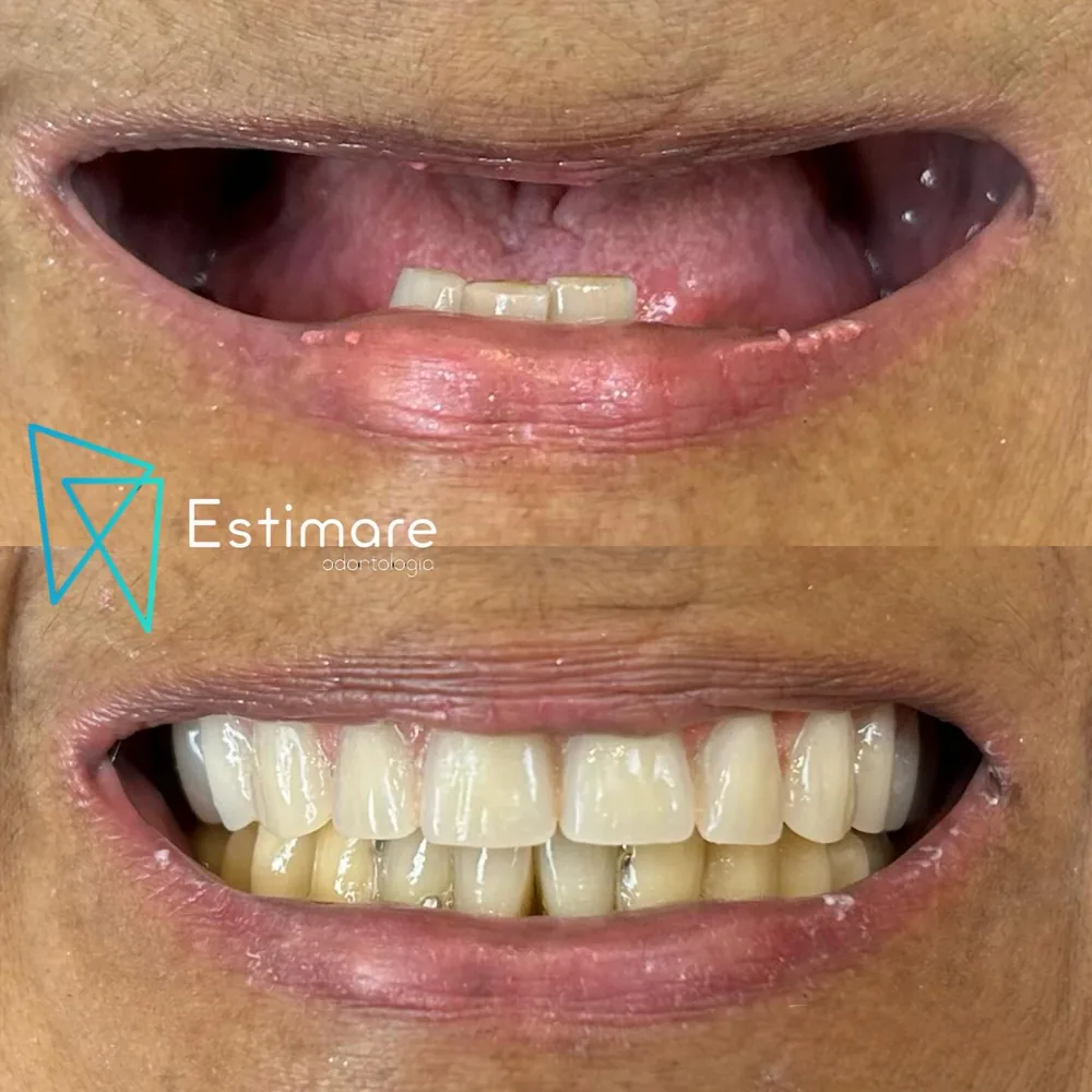 Antes e depois de reabilitação oral na Estimare Odontologia