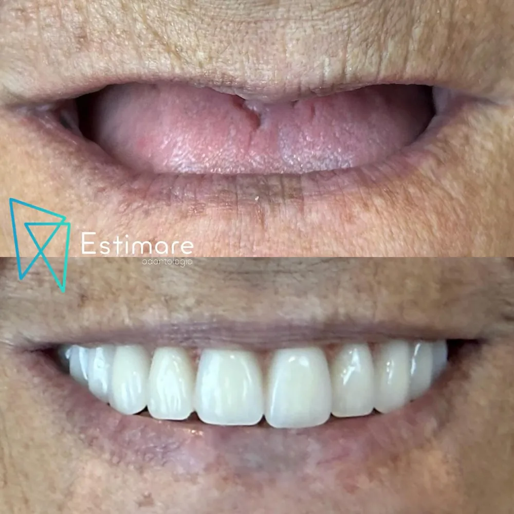 Resultado de dentes fixos em paciente da Estimare Odontologia