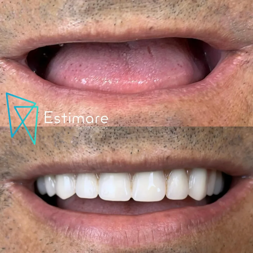 Paciente com protocolo de dentes fixos feito na Estimare Odontologia