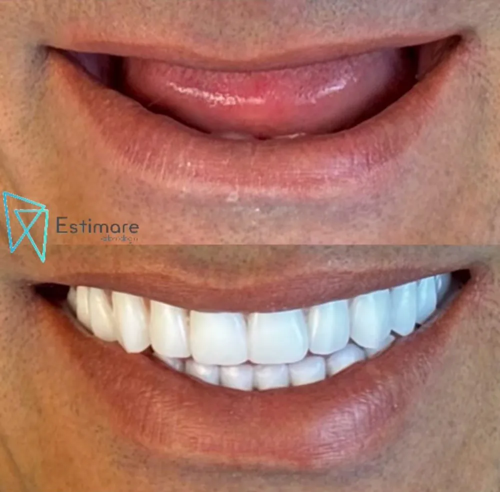 Sorriso antes e depois do tratamento na Estimare Odontologia