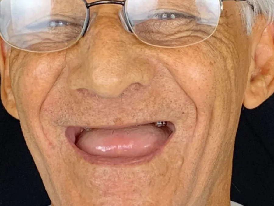 Paciente antes do tratamento, sem os dentes superiores